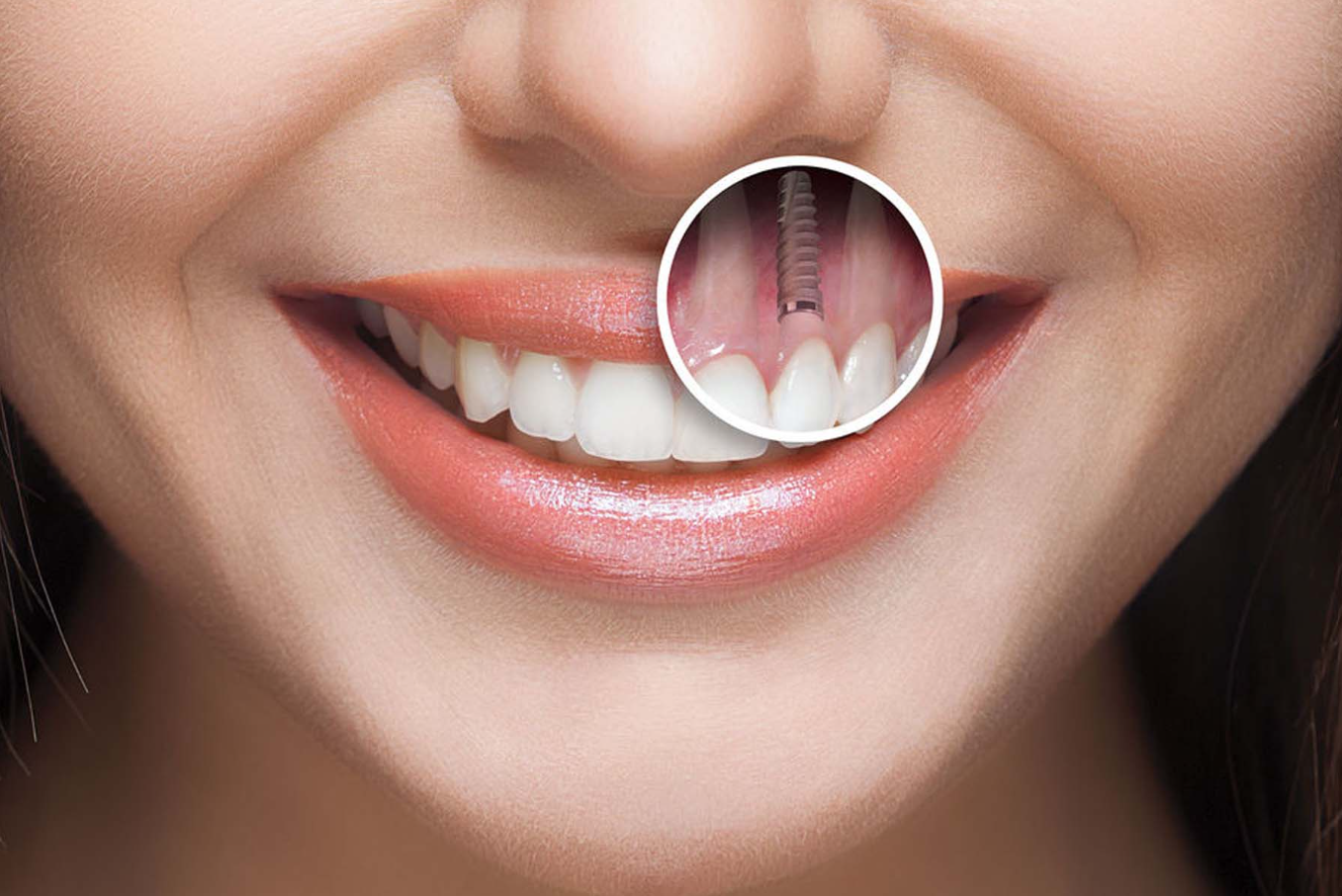 Serenity Health implants